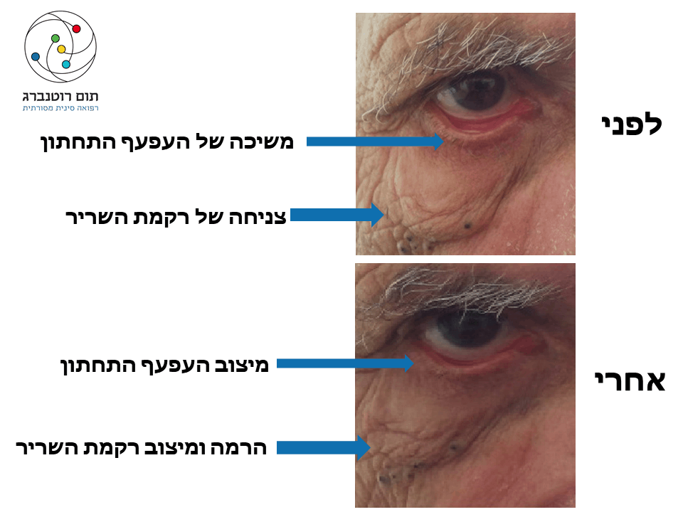 פציאליס בצד ימין בעין - תמונה בשיתוק פנים על שם בל