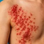 שלבקת חוגרת - הרפס זוסטר